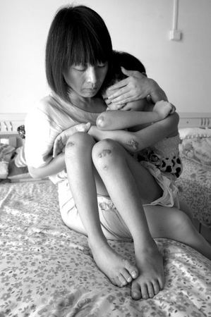 　女童的外傷基本痊愈,，但留下了明顯的疤痕,。京華時報(bào)記者蒲東峰攝