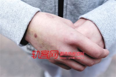 　張燕每天都要隔絕打架的豪豬，白嫩的雙手如今全是傷口
