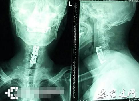 53歲大伯仰頭喝可樂(lè)突然四肢癱瘓