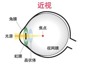 戴眼鏡會(huì)讓眼睛近視度數(shù)加深,？