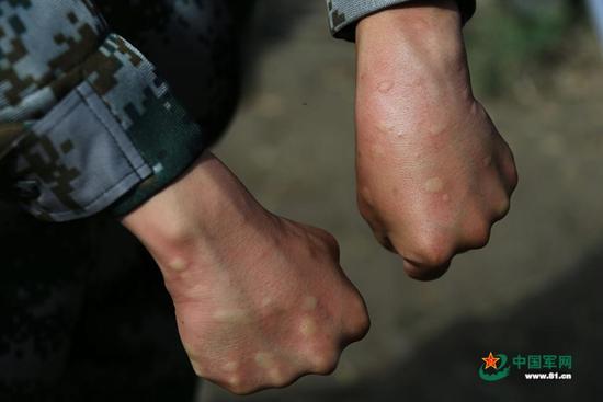 雖然戴著防蚊帽，穿著防護(hù)服，但巡邏回來,，官兵的手上仍被蚊子叮起好多包,。