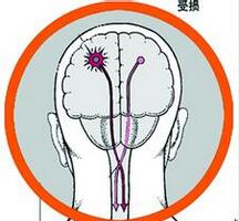 運動保健 兩腳畫圈讓你遠離腦中風(fēng)
