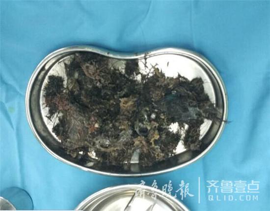 青島女童妙妙（化名）今年5歲了，最近一段時間,，妙妙的父母發(fā)現(xiàn)女兒經(jīng)常喊肚子疼,，于是夫妻倆就帶著女兒到青島的各大醫(yī)院就診,，但是一直沒檢查出原因,。8月初，妙妙在爸爸媽媽的陪同下來到青島市婦女兒童醫(yī)院外科門診就診,。