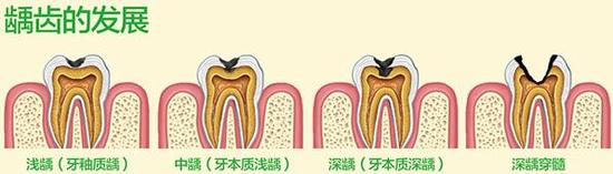 慎用牙簽,？牙縫真的越剔越大嗎