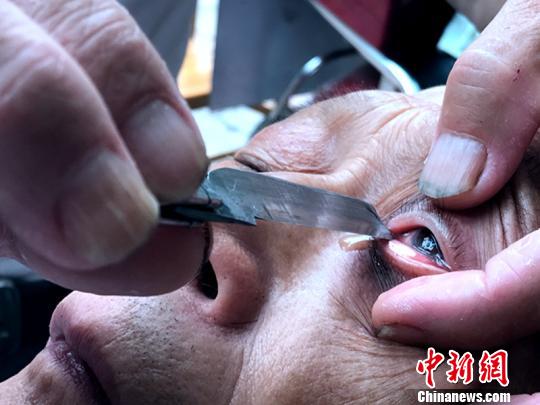 驚險(xiǎn)又刺激的“刀鋒洗眼”,?！螚?攝