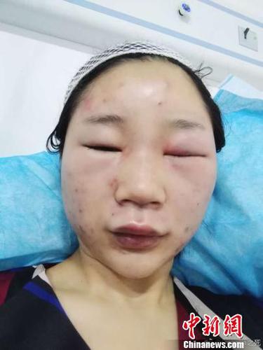 圖為當(dāng)事人提供的傷情圖?！【W(wǎng)絡(luò)圖攝