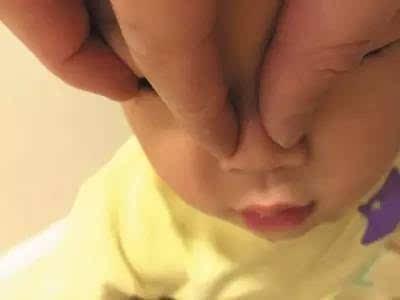 捏鼻梁讓寶寶鼻子變挺,？小心誘發(fā)2種病