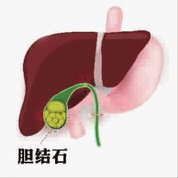 如何護(hù)理膽結(jié)石,？高危人群要注意