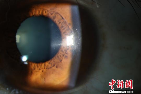 術(shù)后2年,，患者角膜透明,。供圖