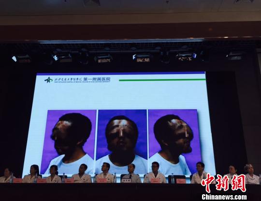 小伙患病貌似“獅面”,，經(jīng)手術(shù)重獲新顏?！￡惙f 攝